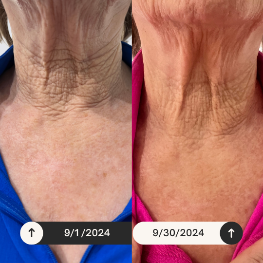 Neck Lift Intensive Firming Neck Cream.