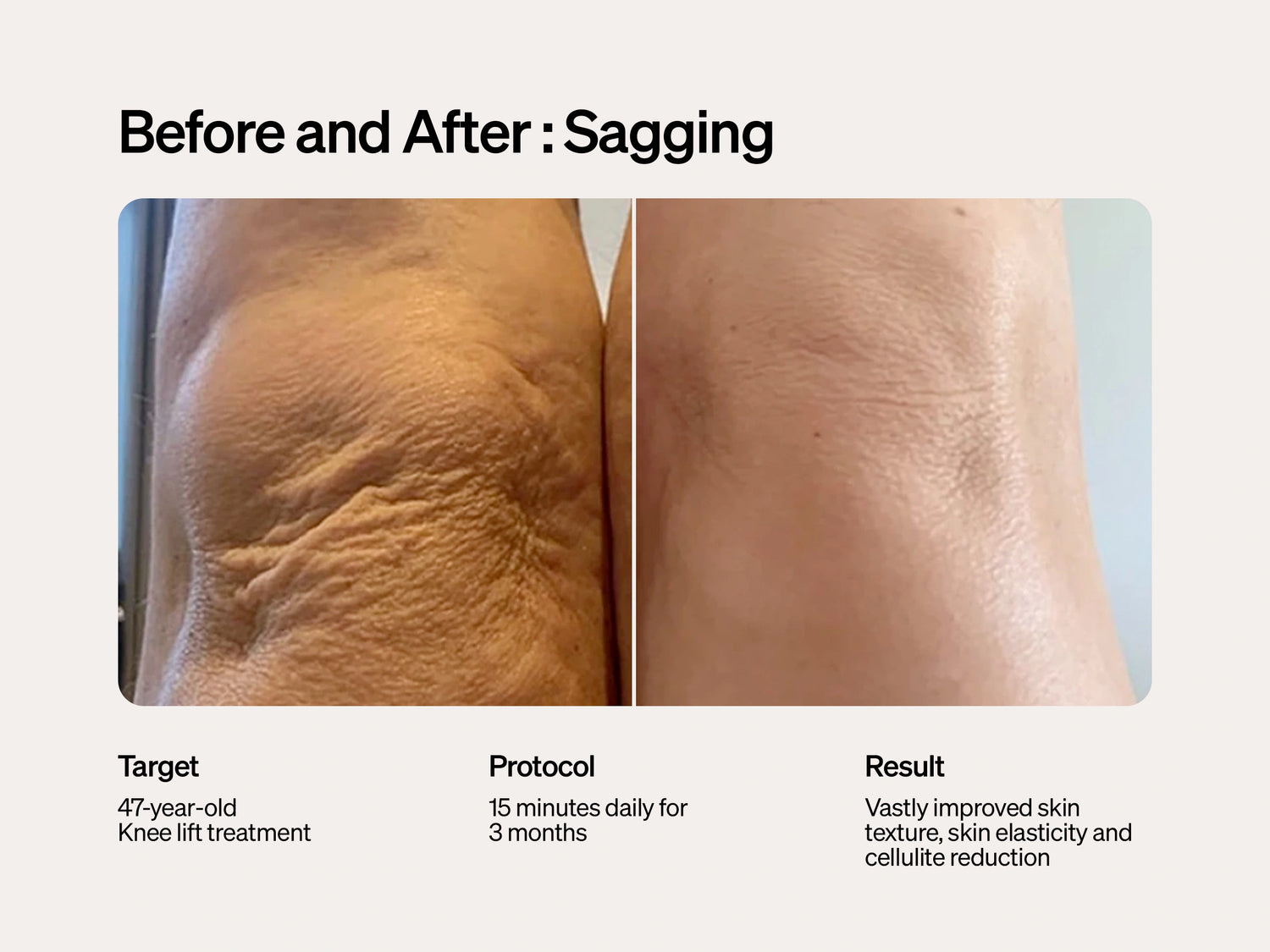 the before and after of the knee sagging with the lyma laser from heaven on earth